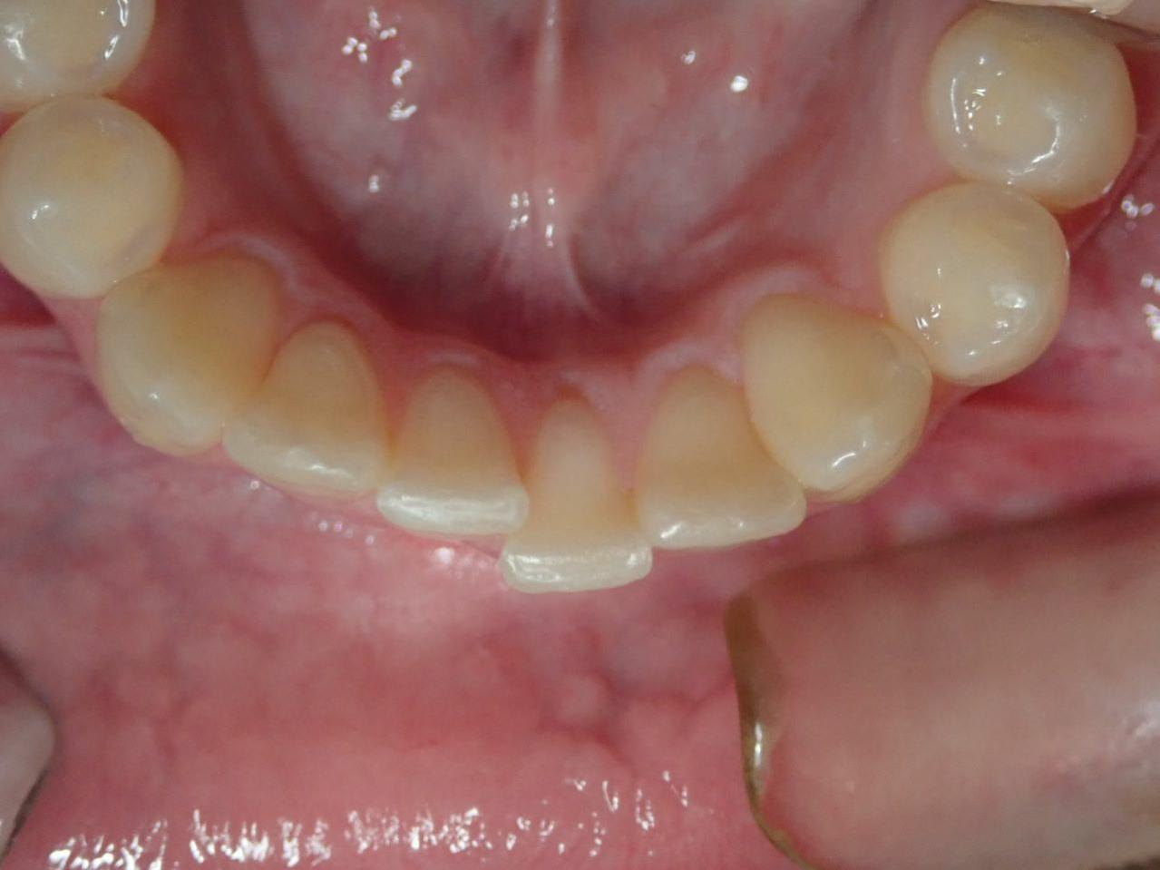 Active Lingual Bond - Example of Upper Teeth